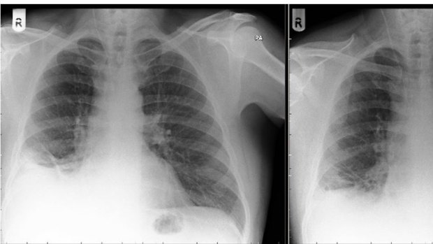 Chest X-rays of a toy cone lodged in the lower zone of a man's right lung. 