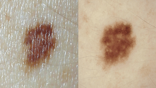 Australia has one of the highest rates of melanoma in the world.