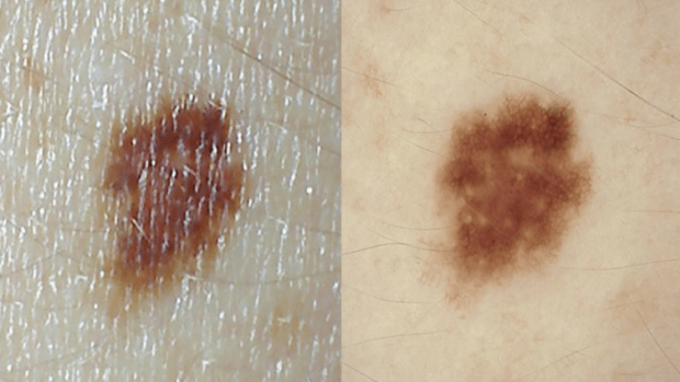 A dermoscope helps your doctor see if your mole has hidden melanoma signs, or if it’s nothing to worry about.