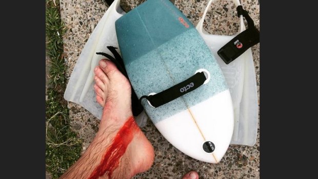 A photo of the bodysurfer's injuries.