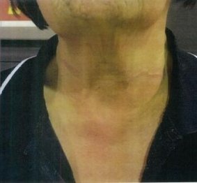 The marks on the cleaner's neck after the attack.