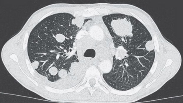 Images show cancerous growths in the patient's lungs ranging in size from 0.4 to 4.4 cm.