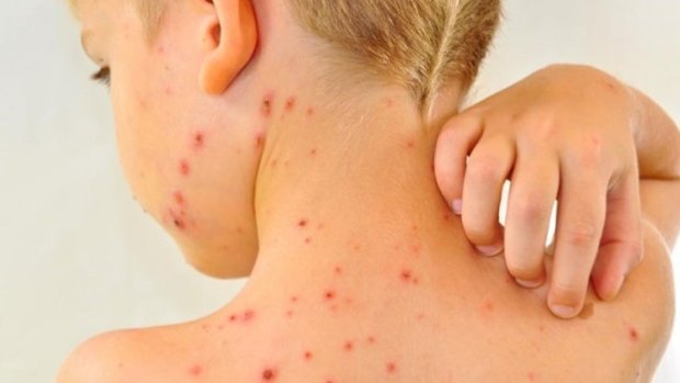The AMAQ and the Queensland premier have lashed out at parents holding 'pox parties' to infect their children with chickenpox.