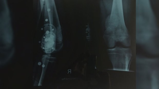 X-rays revealed the cysts.