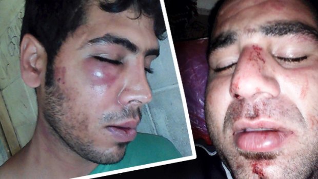 The injuries of two Iranian refugees, Mehdi (left) and Mohammad, allegedly bashed by local authorities on Manus Island.