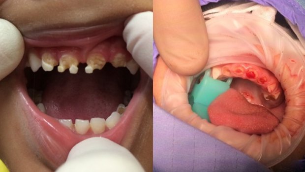 A three-year-old had 11 teeth extracted, and (right) a two-year-old was often given soft drink, which had dissolved the teeth down to the gum, exposing the nerve. 
