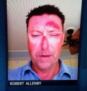 A photo showing Robert Allenby's injuries after the incident in Hawaii. 