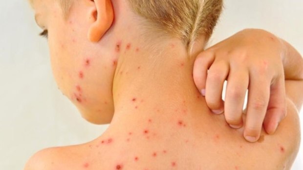 The AMAQ and the Queensland premier have lashed out at parents holding 'pox parties' to infect their children with chickenpox.