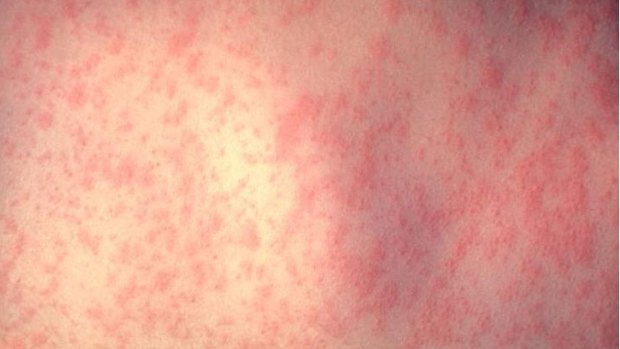 An employee at Big W, Werribee Plaza has contracted measles.
