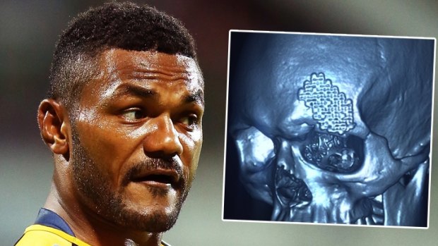 Uphill battle: A fracture above his left eye means Henry Speight has been limited to just two tournaments with the Australian Sevens team.