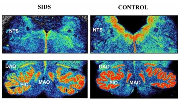 University of Adelaide researchers have identified developmental abnormality in the brains of a subset of SIDS babies.
