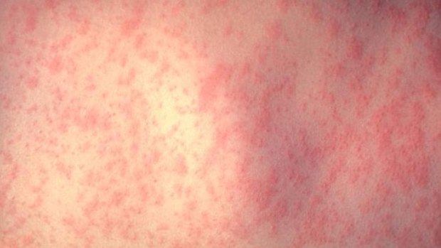 The confirmed measles case is the second in two days for Brisbane.