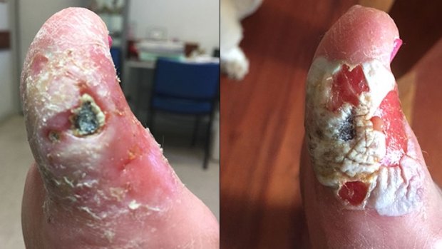 a nail salon employee poured chemical metal steriliser over a woman's foot believing it would act as an antiseptic for a deep cut caused by a blade.