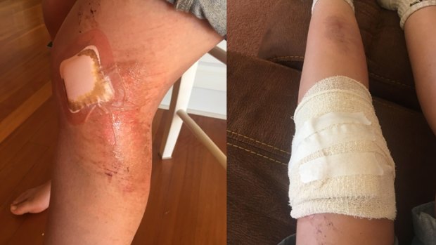 Festival-goer Olivia Jones' injured leg as a result of the stampede at Lorne Falls Festival.
