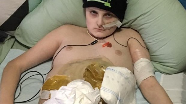 Liam Parr, 16, on Sunday after his colostomy bags ruptured.