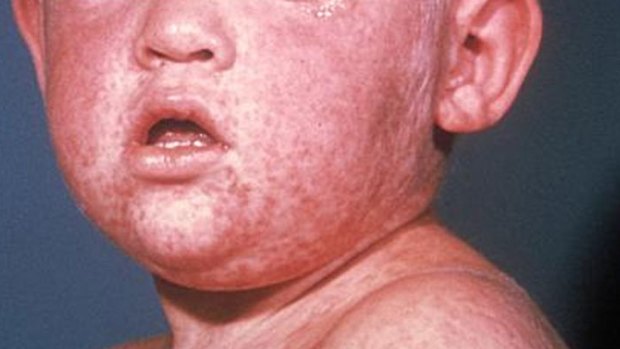 The measles rash on the face of a child.