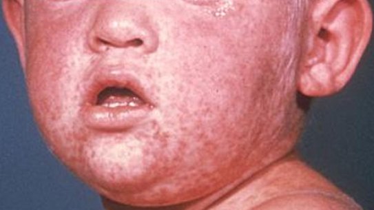 The measles rash on the face of a child.