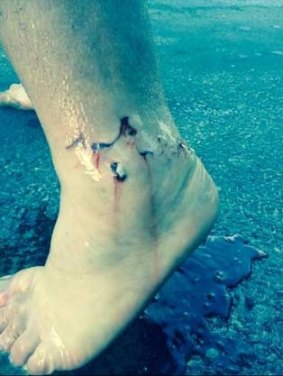 The man's ankle after he was bitten near Batemans Bay.