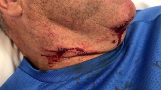 The injury that came within millimetres of Cam McIntyre's carotid artery.