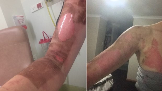 Burns suffered by Danika Jones in Perth after a her Thermomix allegedly burst open when in use in March this year.