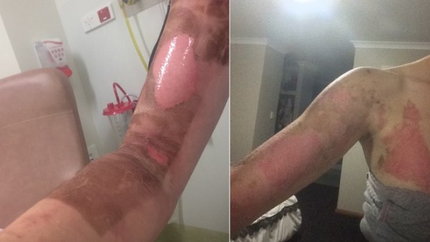 Burns suffered by Danika Jones in Perth, after a her Thermomix allegedly burst open when in use, in March this year.