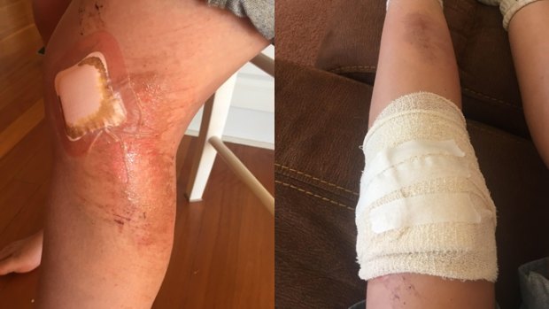 Festival-goer Olivia Jones' injured leg as a result of Friday night's crush.