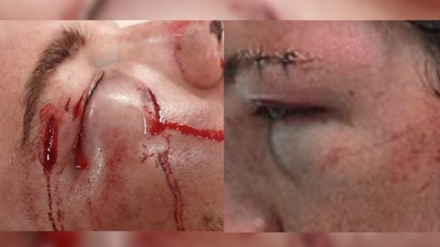 The 23-year-old man was left with a fractured eye socket, a perforated ear drum, nerve damage and significant bruising to his face.