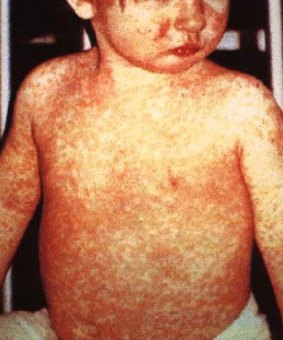 A child with a bad case of measles.