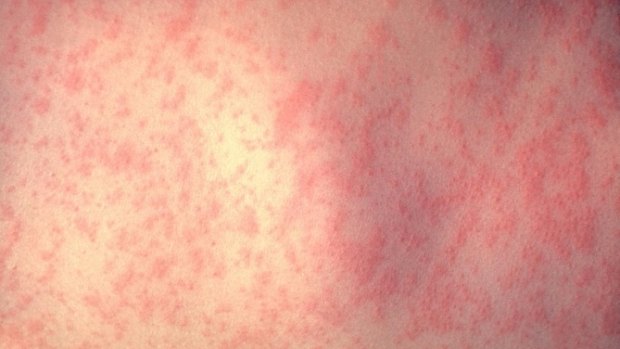 A typical measles rash.