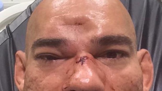 Ouch: Evangelista 'Cyborg' Santos fractured his skull in his bout with Michael Page.