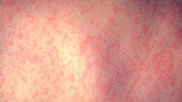 A typical measles rash.