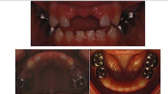 'Things just exploded in his mouth': kids' tooth decay unnoticed in Perth