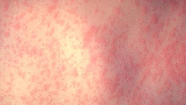 South-east Queensland has now had four confirmed measles cases in the last week.
