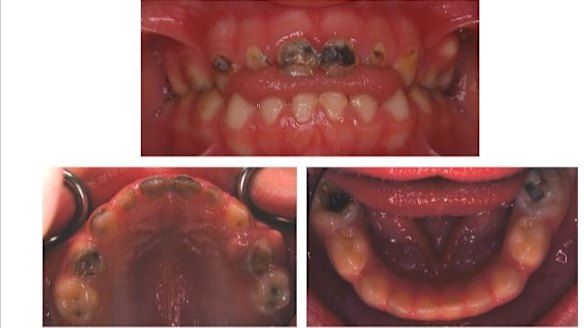 'Things just exploded in his mouth': kids' tooth decay unnoticed in Perth