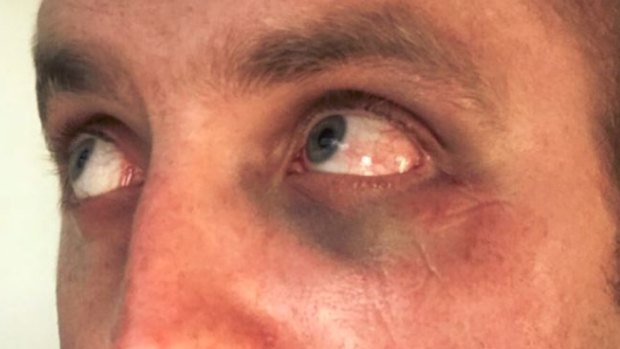 The bruised eye of the police officer who was assaulted at Highpoint on Boxing Day.