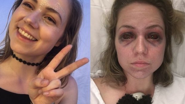 Falls Festival stampede victim 'Maddy' said she still doesn't have white in her eyes 'it's just blood' after she was trampled on.