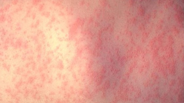 A case of measles has been confirmed in Brisbane's north.