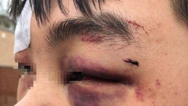 A Chinese student allegedly assaulted in Canberra's south last week. The photo was taken by friends of the victim.