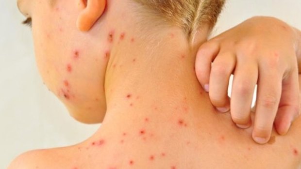 The AMAQ and the Queensland premier have lashed out at parents holding 'pox parties' to infect their children with chickenpox.