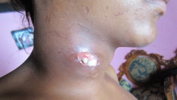 A West Timor local resident shows a neck cyst in 2011. 