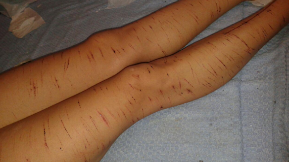 A female refugee on Nauru who according to the Amnesty report has been self-harming.