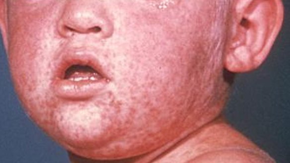 The measles rash on the face of a child.