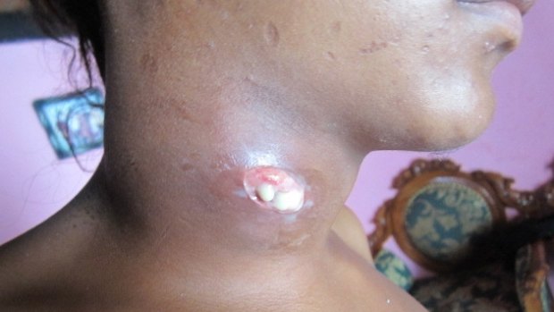 A West Timor local resident shows a neck cyst in 2011. 