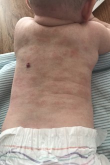 Poppy eczema back