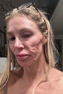 Brandi Glanville face disfigurement