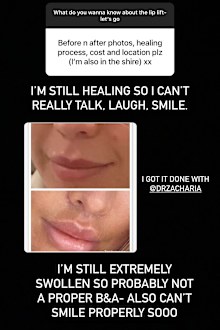 MAFS bride Coco hold Q&A on lip lift 