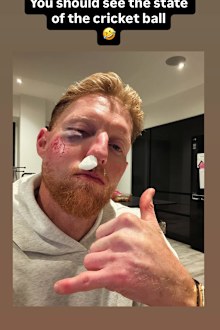 Ben Stokes, yüzündeki yaralanmanın boyutunu Instagram'da paylaşıyor.