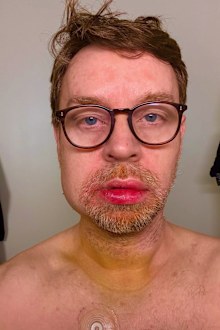 Darren Hayes jaw injury