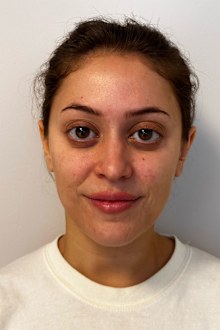 Emily Cipryk had a mid-facelift at 28.