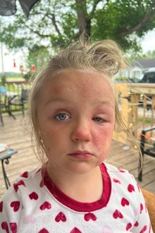 Mum warns against deadly 'poison hemlock' plant after daughter's horrible reaction.